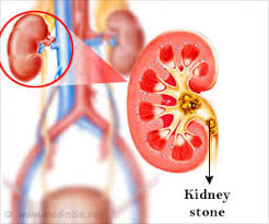 Doctors Remove 420 Kidney Stones From A Patient In China