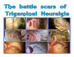 Pin By Kathy Roper On Tn Trigeminal Neuralgia Symptoms Trigeminal Neuralgia Neuralgia Symptoms