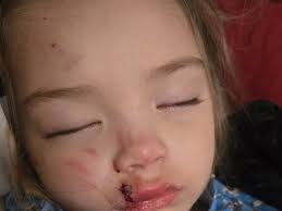 Fundraiser by Windy Manning : Help Echo Heal After a Dog Attack