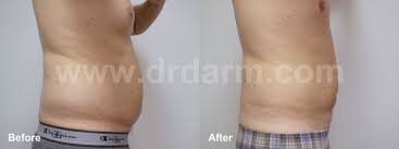 Pin On Laser Body Sculpting