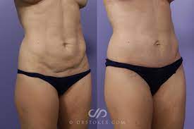 Definitive guide on mini tummy tuck, including the procedure overview, benefits, risks, recovery, before & after photos, costs, and more. Mini Tummy Tuck Before And After Photo Gallery Los Angeles Ca Stoker Plastic Surgery