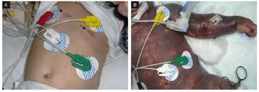 A lumbar puncture can be done to make a diagnosis. Purpuric Rashes And Purpura Fulminans In A Case Of Meningococcal Download Scientific Diagram