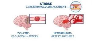 Image result for Stroke Pathophysiology