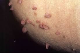 Image result for Skin Tag