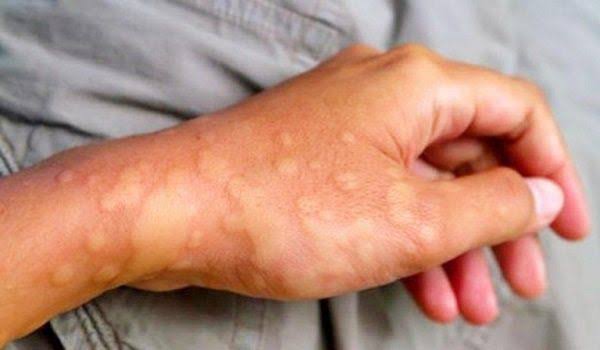 Ngứa tay chân kèm nổi cục từng mảng dấu hiệu bệnh gì? | Vinmec