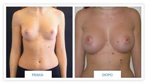 Prima e dopo chirurgia protesi 320 cc anatomiche Mastoplastica additiva
