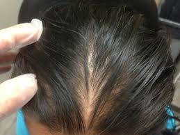 Use a shampoo containing green tea caffeine which blocks dht production and stimulates hair growth. Alopecia Hair Loss The Dermatology Specialists