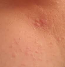 What are scales and how to remove them from cactus and succulents? Hedgehog Hives Heavenly Hedgies