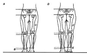 Image result for Functional Leg Length Discrepancy