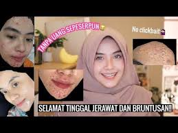 Masalah jerawat yang timbul pada wajah harus dibiarkan tanpa diusik, termasuk memencet jerawat sampai pecah karena dapat mengundang pembentukan parut dan infeksi kuman pada wajah. Cara Menghilangkan Jerawat Bruntusan Dan Breakout Selamanya Tanpa Uang Youtube Jerawat Youtube