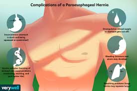 Hiatal hernias can occur for a number of reasons, including to identify a hiatal hernia, a health care provider may use multiple diagnostic techniques but will begin with a any instance in which the stomach or abdominal organs rotate or twist, causing severe pain, blockage. Paraesophageal Hiatal Hernia Complications