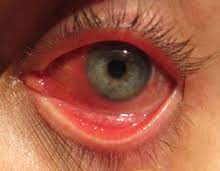 Diese form der bindehautentzündung ist überaus ansteckend und kann. Konjunktivitis Wikipedia