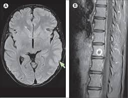 Louis encephalitis virus usually causes encephalitis in healthy individuals in neurodiagnostic evaluation, demonstration of temporal lobe edema and /or bleeding with magnetic resonance imaging (mri) is supportive for diagnosis. Brucellosis Mimicking Herpes Simplex Virus Encephalitis The Lancet Infectious Diseases