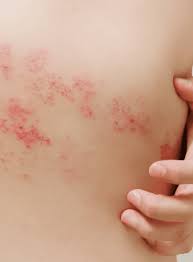 Image result for shingles in children