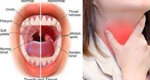 Milk Onion And Thyme Against Sore Throat Recipe Throat Infection Sore Throat Strep Throat