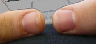 Fingernagel Nagel Lost Sich Schnell Von Haut Bild
