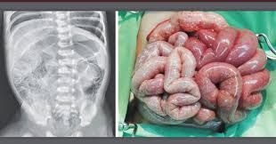Image result for Necrotizing Enterocolitis