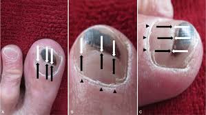 Image result for Beau lines feet