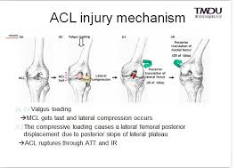 To ensure that acls are semantically correct, use the appropriate functions to. Aspetar Ø³Ø¨ÙŠØªØ§Ø± On Twitter Acl Injury Mechanism By Hideyuki Koga Handballmedicine Http T Co Yhnni07gqq