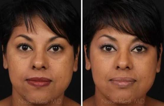 Treat Facial Volume Loss Without Surgery | Filler Guide