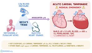 Medical definition for the term 'sign'. Beck S Triad What Is It Associated Conditions And More Osmosis