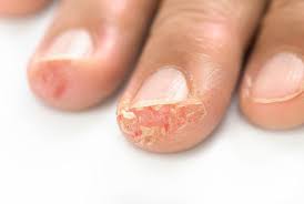 Image result for dyshidrosis