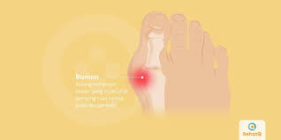 Keluhan tersebut juga bisa terjadi jika anda. Bunion Tanda Dan Gejala Penyebab Cara Mengobati Cara Mencegah