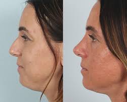 Best Rhinoplasty & Revision Rhinoplasty in The Woodlands, TX