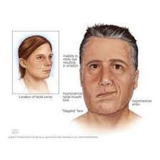 Image result for Progressive Bulbar Paralysis