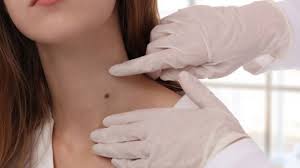 Las verrugas comunes son causadas por un virus y se transmiten por el tacto. Cuando Ir Al Dermatologo Si Tengo Un Lunar O Verruga