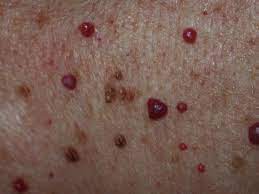 These benign lesions form when blood vessels, called venules, dilate and proliferate. Cherry Angioma Symptoms Causes And Treatment