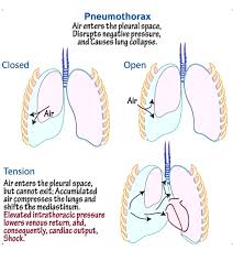 Image result for Open Pneumothorax