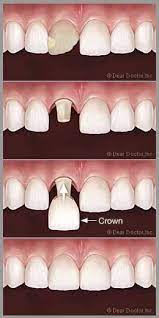 Dentaltown Where The Dental Community Lives Estetica Dental Dental Coronas Dentales