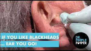 Click here for the biggest archive of pimple popping videos. If You Like Blackheads Ear Ya Go Youtube