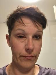 What are the best options for treating Chiari malformation and finding a  specialist?