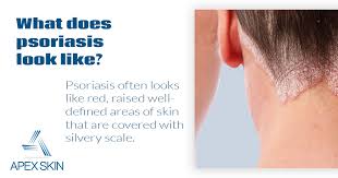 Image result for psoriasis