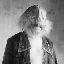 Image result for Hypertrichosis