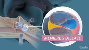 Meniere S Disease Ent Health