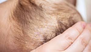 bebeklerde konak neden olur sactaki konak nasil temizlenir