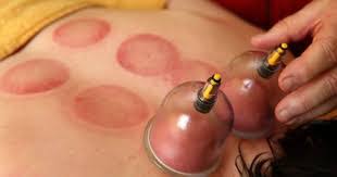 Image result for medicupping
