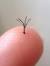 Deep Ingrown Hair