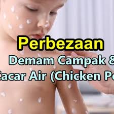 Aplikasi berkenaan demam campak ini menerangkan kepada anda bagaimanakah demam campak ini terjadi dan cara pencegahan serta rawatan yang diberikan.semua golongan ibu bapa haruslah. Ketahui Perbezaan Demam Campak Dan Cacar Air
