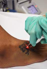 Laser tattoo removal in tucson. Tattoo Removal In Tucson Arizona Astanza Laser