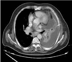 Individual patient characteristics (eg, loculated vs circumferential, recurrent pericardial effusion, need for pericardial biopsy and location of pericardial effusion) and local practice patterns aid in deciding the optimal method of drainage. Ct Showed Loculated Massive Pleural Fluid Multiple Loculations Download Scientific Diagram