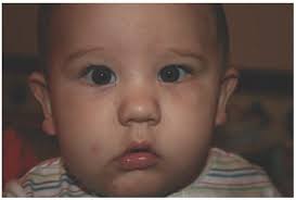 In asians it is normal, but in caucasians it may indicate an underlying syndrome. Strabismus Disorders Ento Key