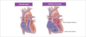Ebstein's anomaly (ea) is a cyanotic congenital heart disease (chd) characterized by the downward displacement of the septal and posterior leaflets of the tricuspid valve (tv). Ebstein S Anomaly Boston Children S Hospital