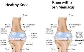 After surgery treatment may vary depending on the symptoms and the surgeon. Meniscal Tear Repair