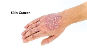 It varies depending on the size. Treatment Of Skin Cancer On Leg
