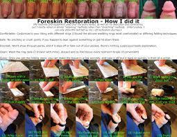 Foreskin restoration with o rings