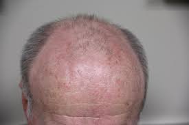 Fluorouracil is in a class of medications called antimetabolites. Patient Observations Whilst Using 5 Fu Efudex Victoria Skin Cancer Screening Early Diagnosis Skin Cancer Screening Victoria Bc